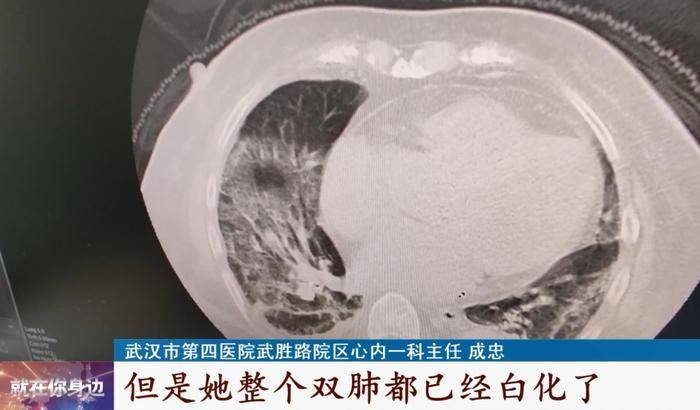 70岁老人没发烧不咳嗽，一查双肺都已白化！重要提示：老年人感染初期可能只是低烧